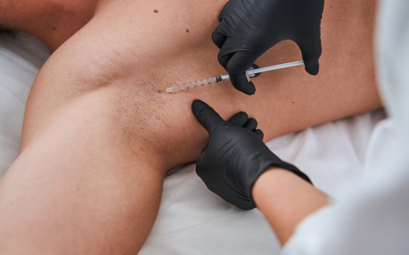 Botolinumtoxininjektion gegen Achselschweiss bei Hyperhidrose