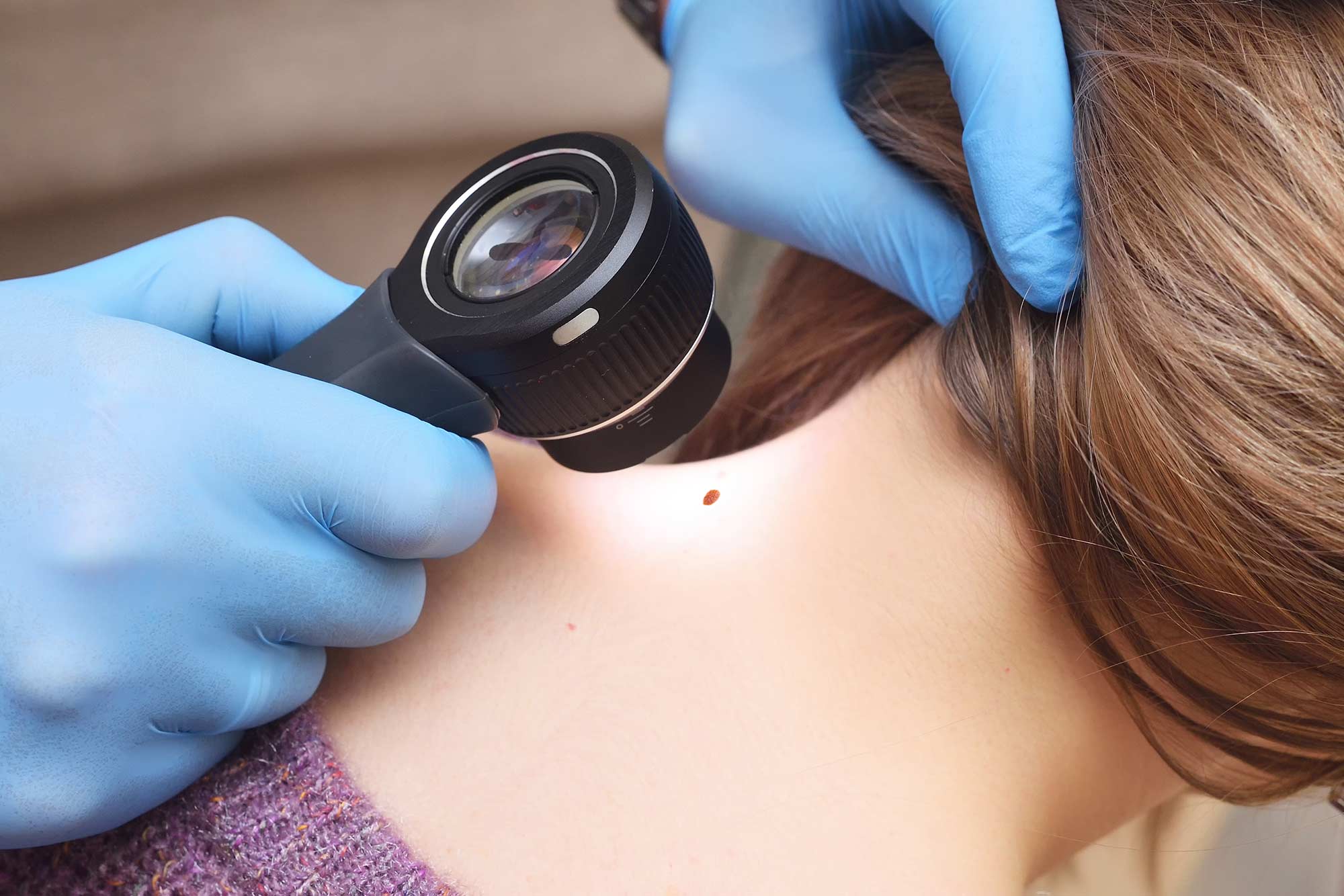 Hautarzt untersucht Muttermal mit einem Dermatoskop am Nacken einer Frau