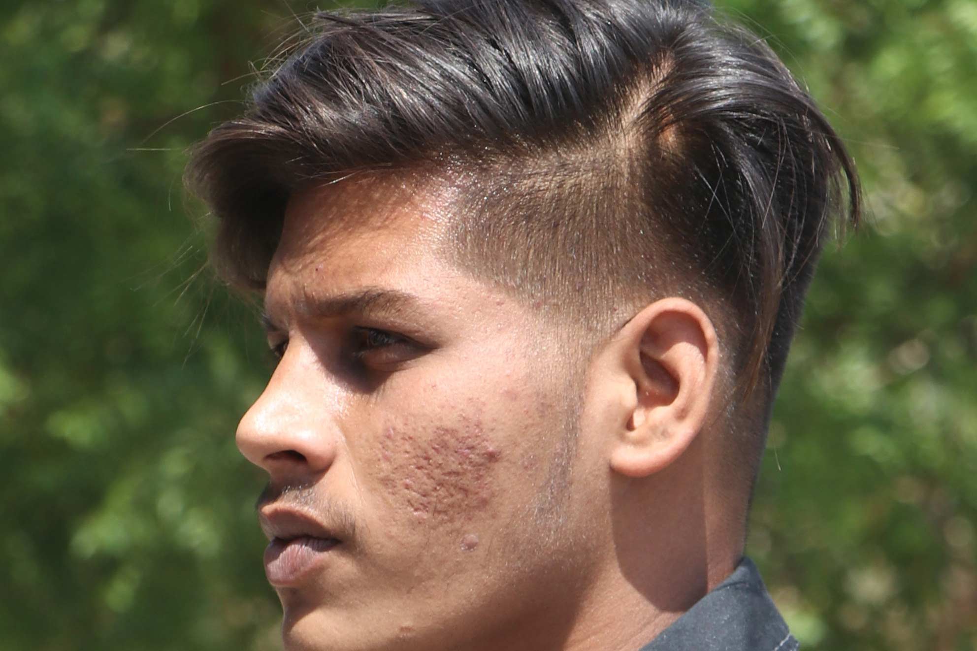 Junger Mann mit dunklen Haaren und Akne auf der linken Wange.