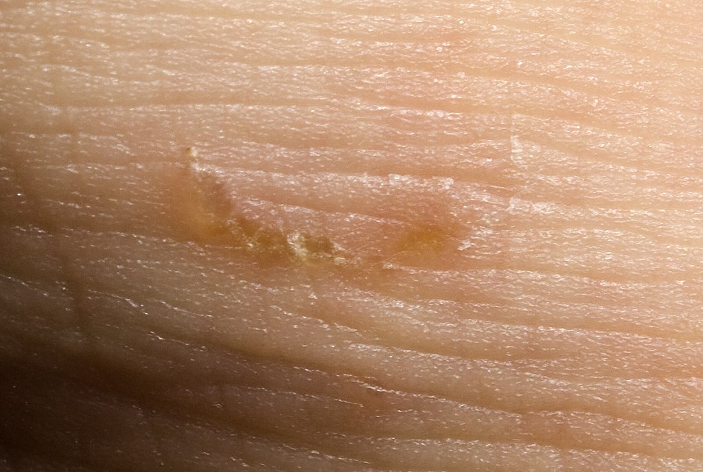 Krätze (Scabies): Wirkungsvolle Tipps zur Behandlung