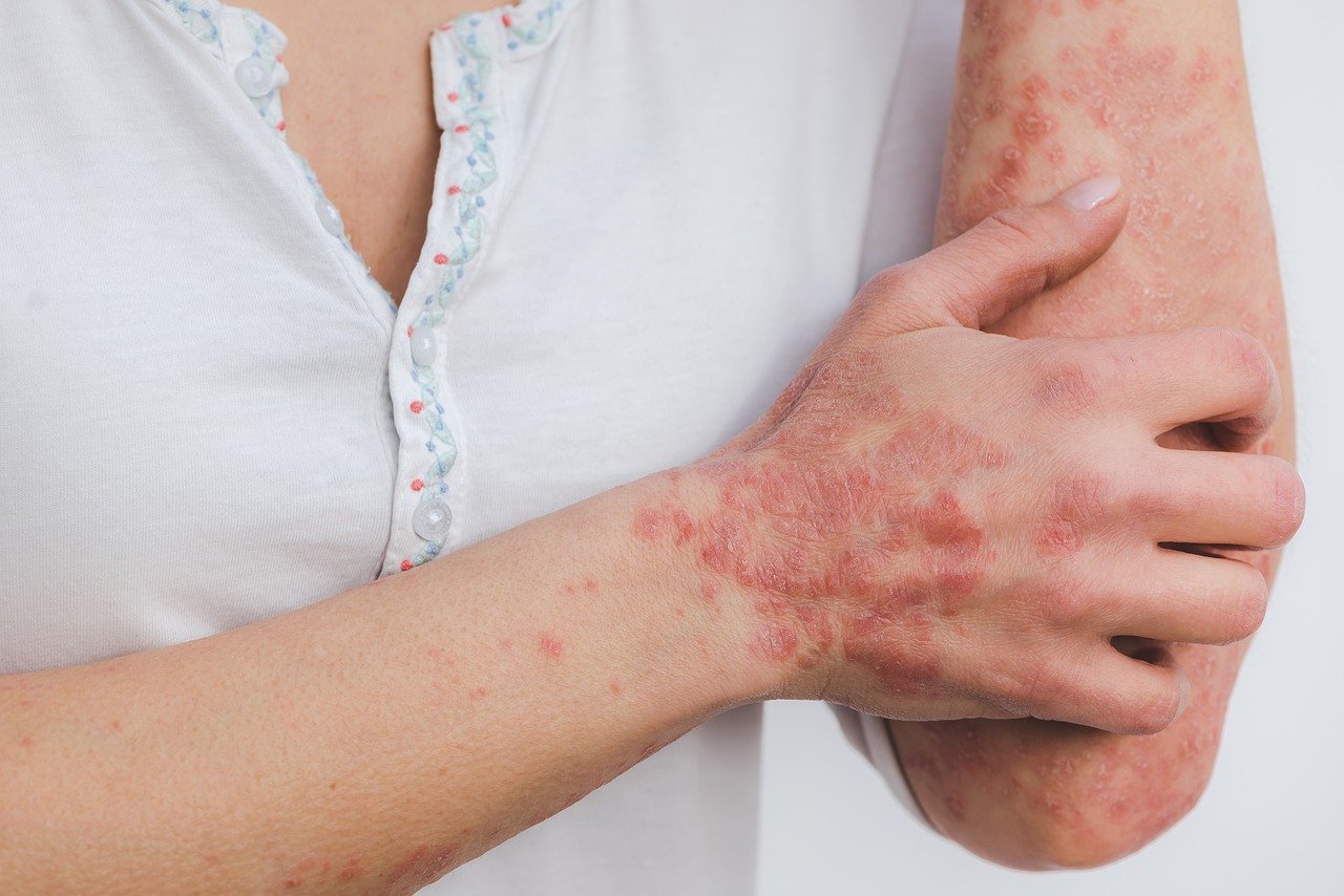 psoriasis vulgaris - gewoehnliche schuppenflechte